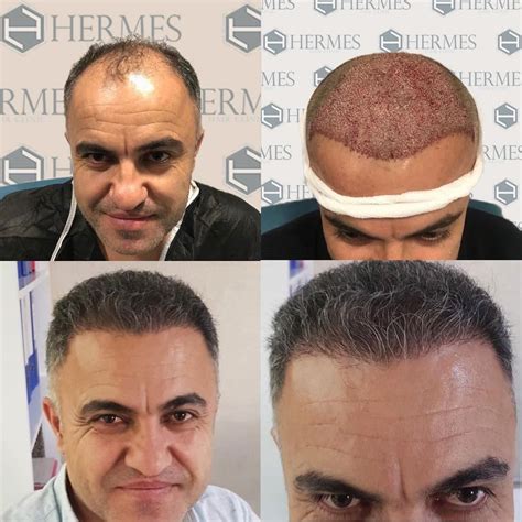 hermes hair clinic istanbul